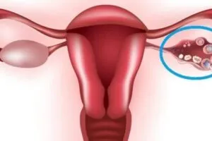 Ovarian Cyst Diagram