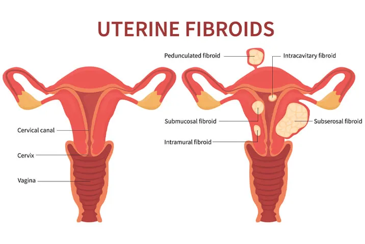 Uterine Fibroids